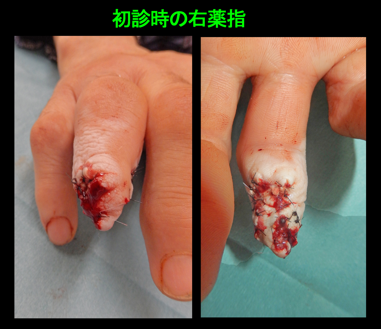 57才　右環指１.jpg