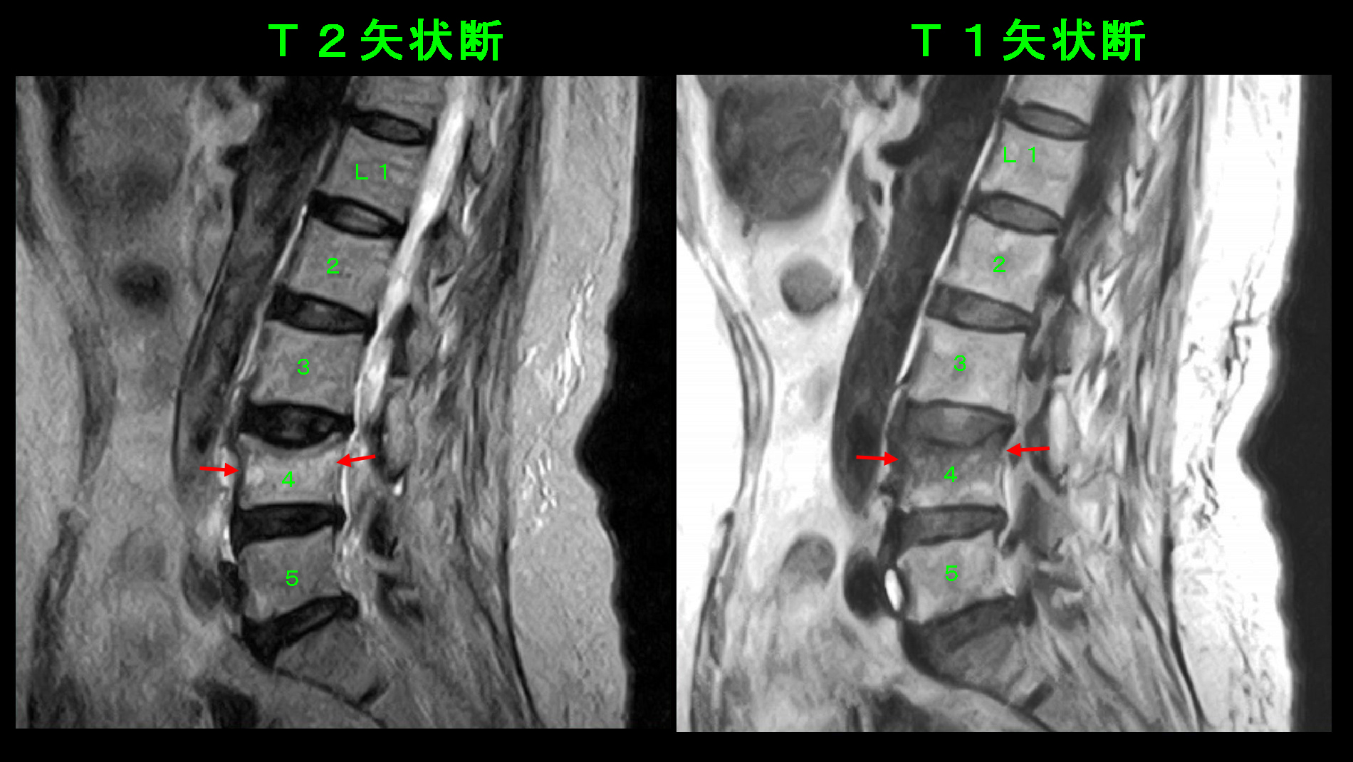 71才女　MRI１.jpg