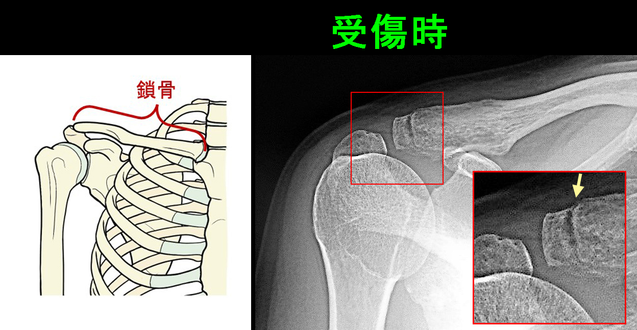鎖骨遠位端骨折１ｄ.jpg