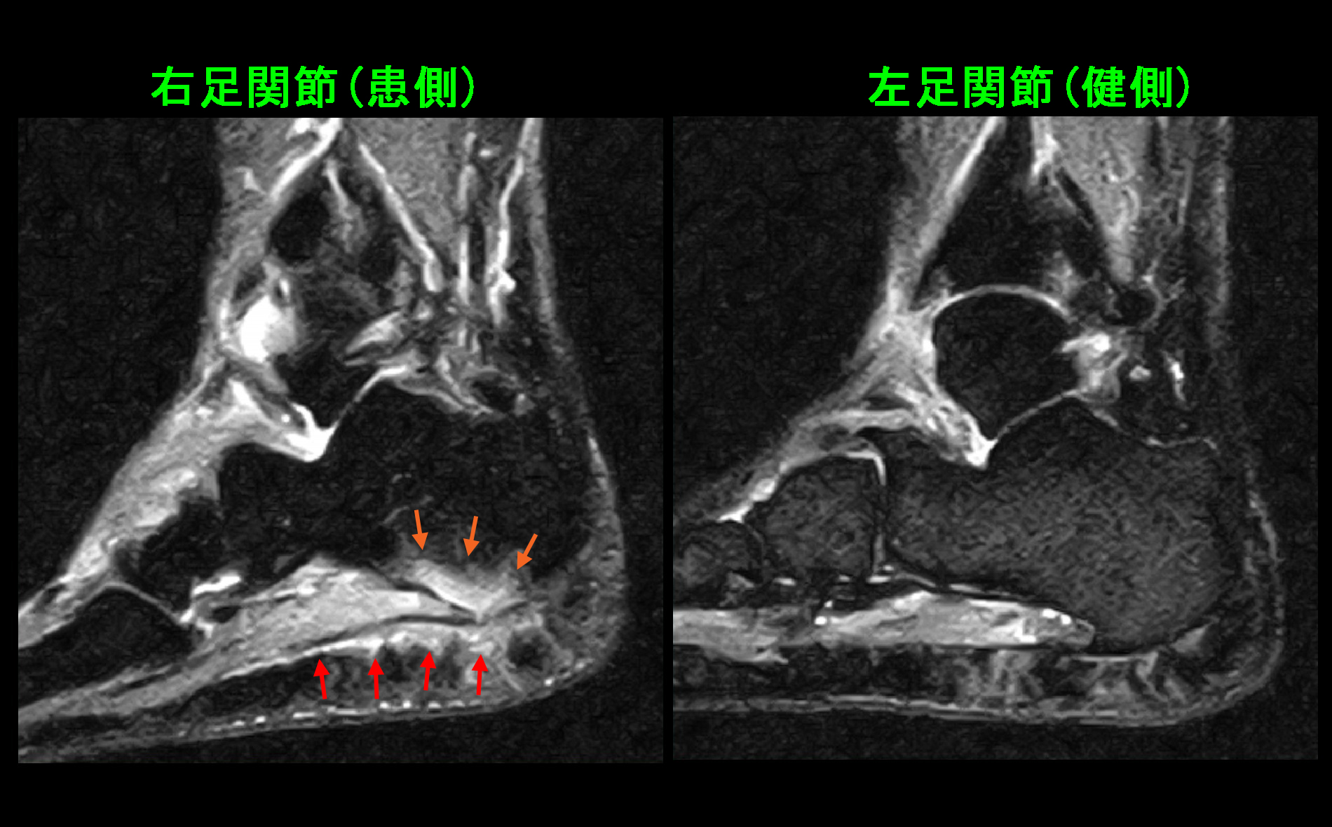 初診時MRI.jpg