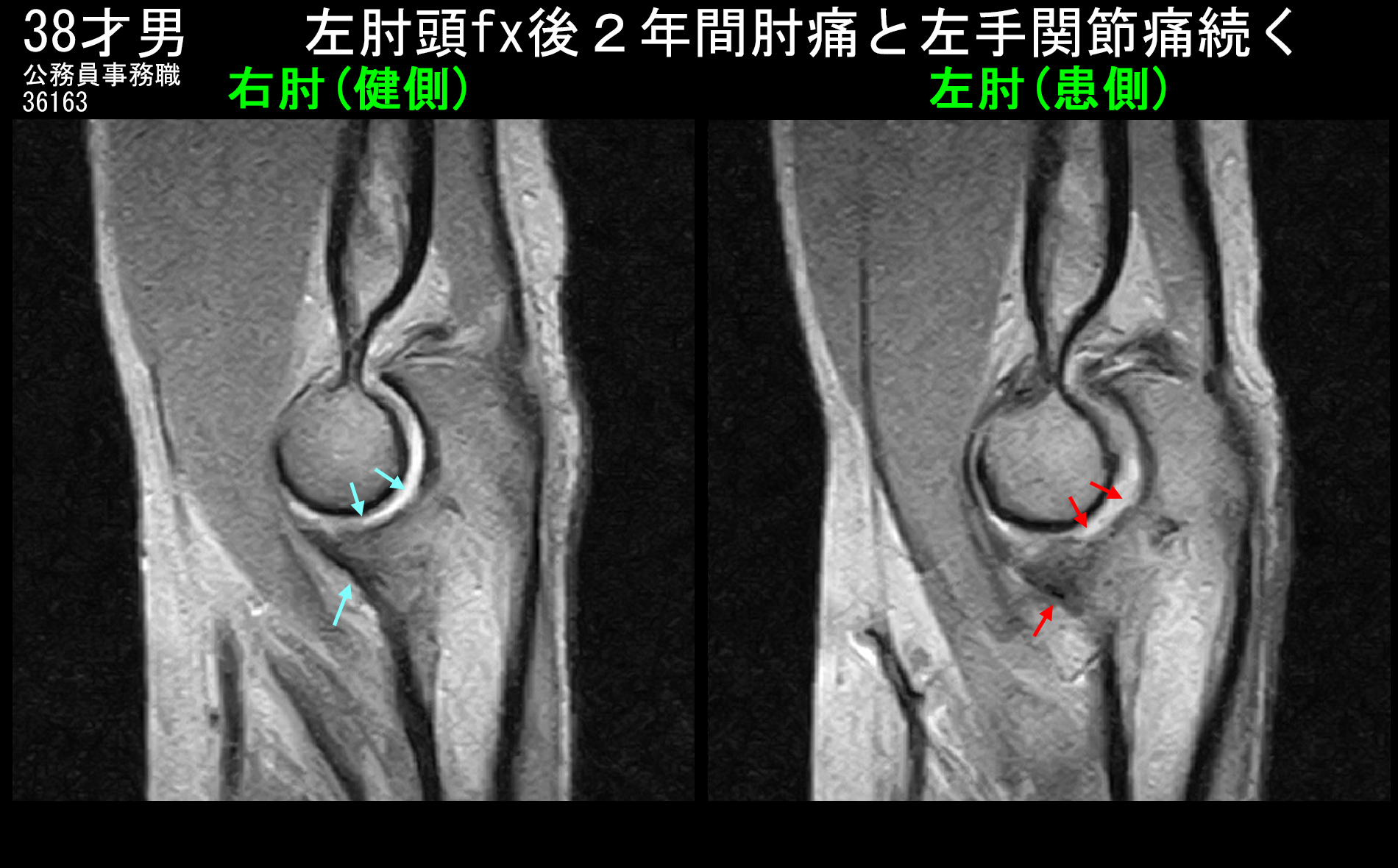 38才男MRI３.jpg