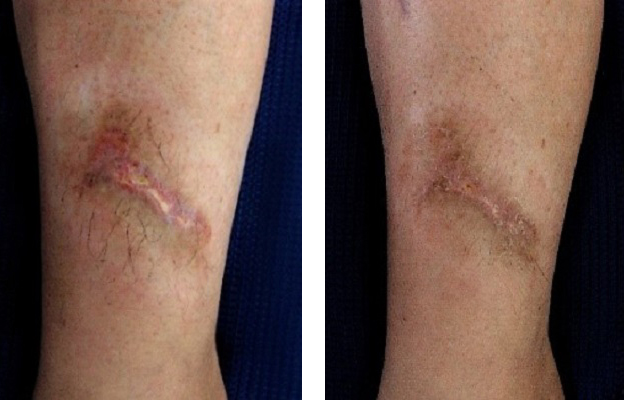 下腿の創 経過.jpg