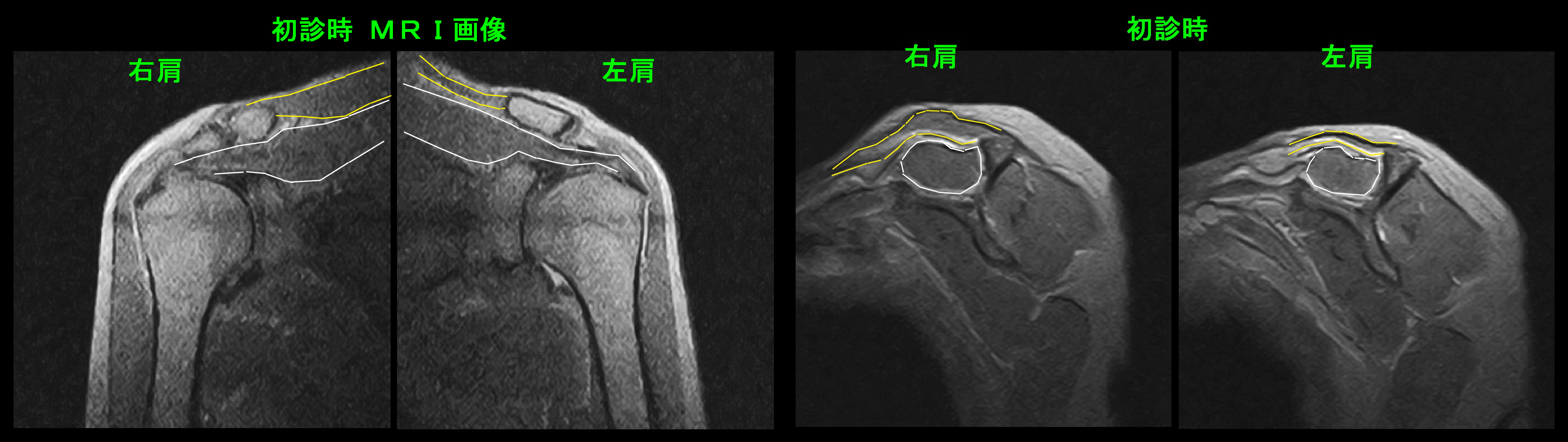 初診時・MRI.jpg