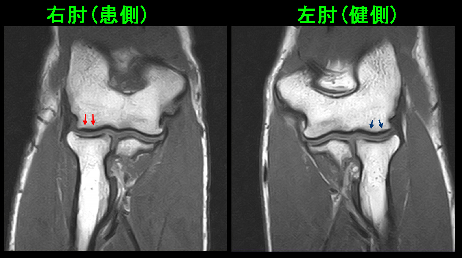 46才男ボクシングMRI3.jpg