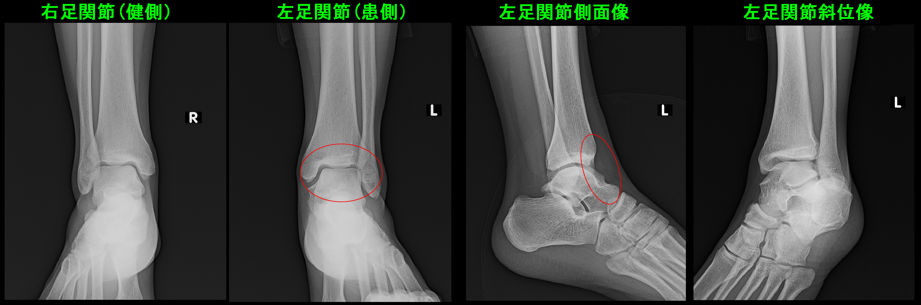 足関節Xp.jpg