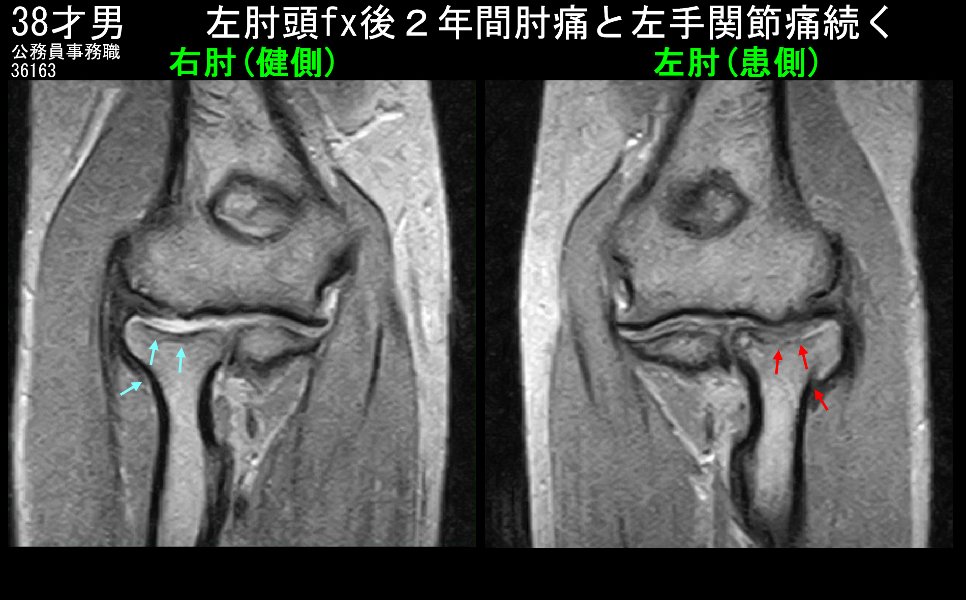 38才男MRI１.jpg