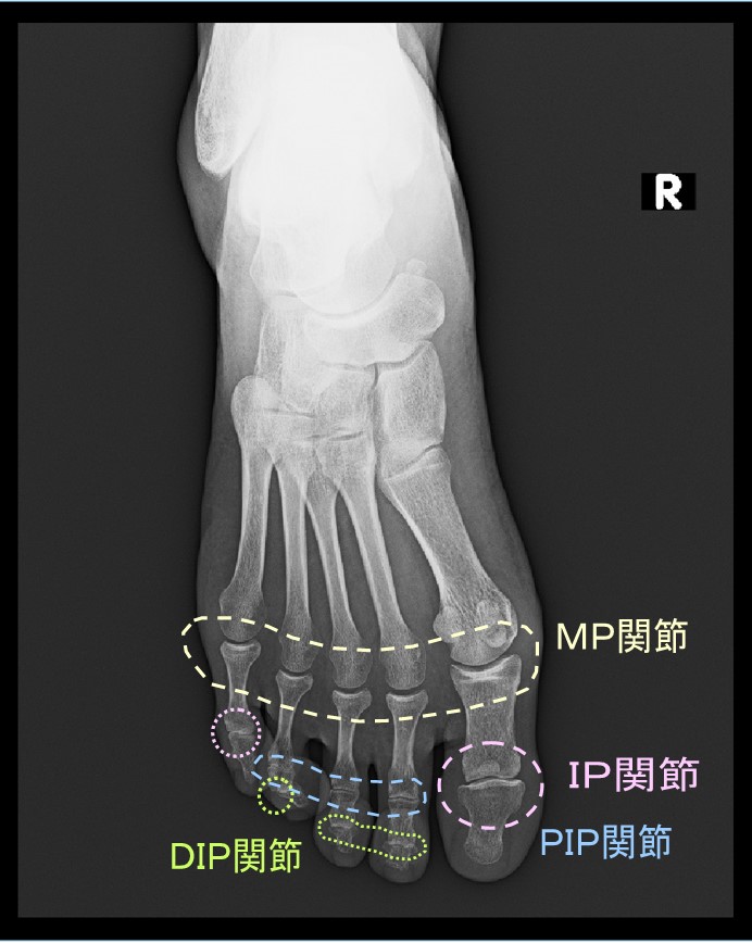 足趾の関節の名称.jpg