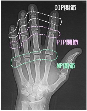手指の関節.jpg