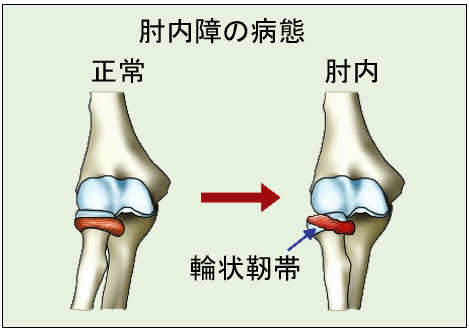 肘内障の病態.png