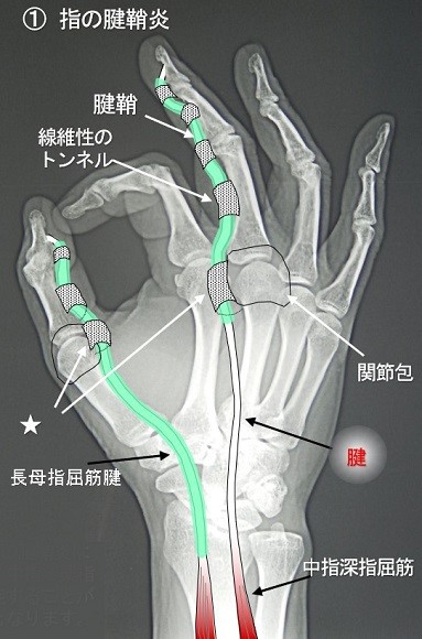腱鞘炎・図.jpg