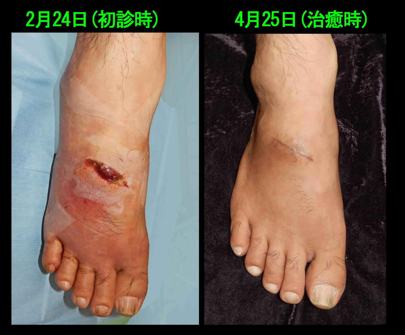53才右足・挫創５.jpg