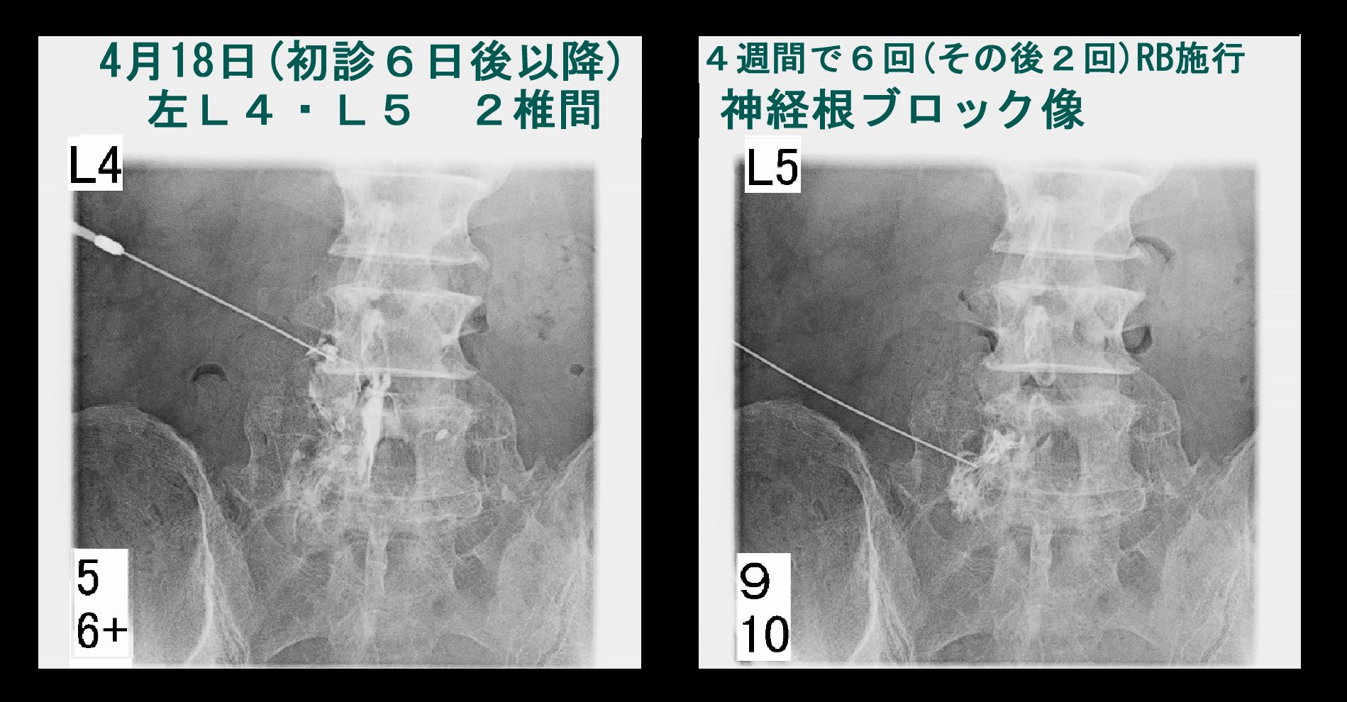 67才男　RB.jpg