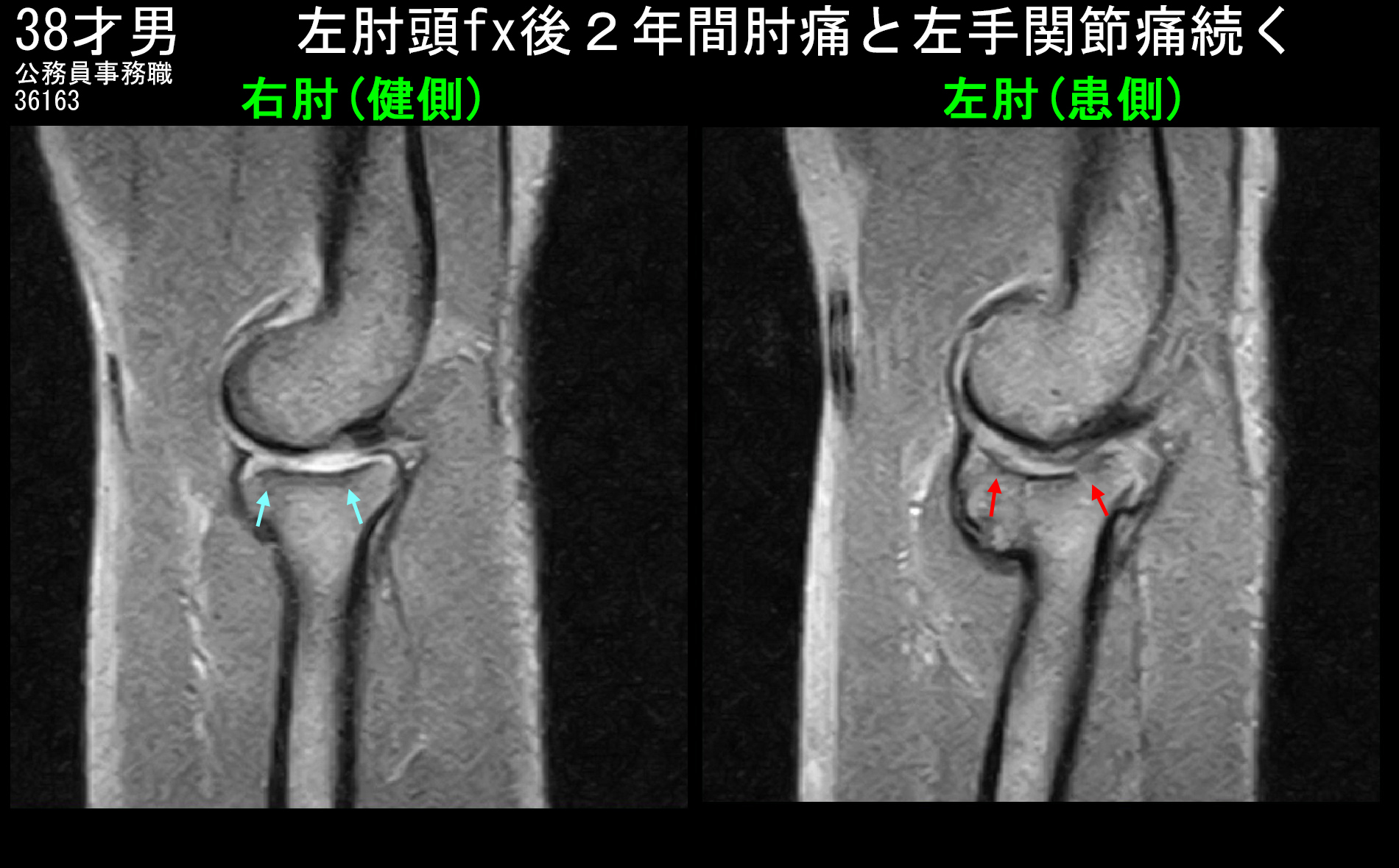 38才男MRI２.jpg