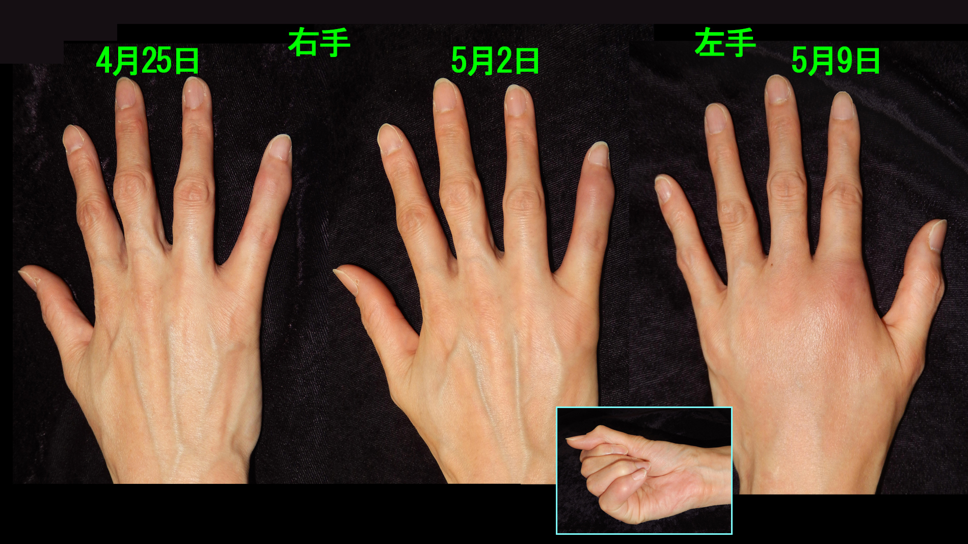 49才女　RA誤診フォト2.jpg