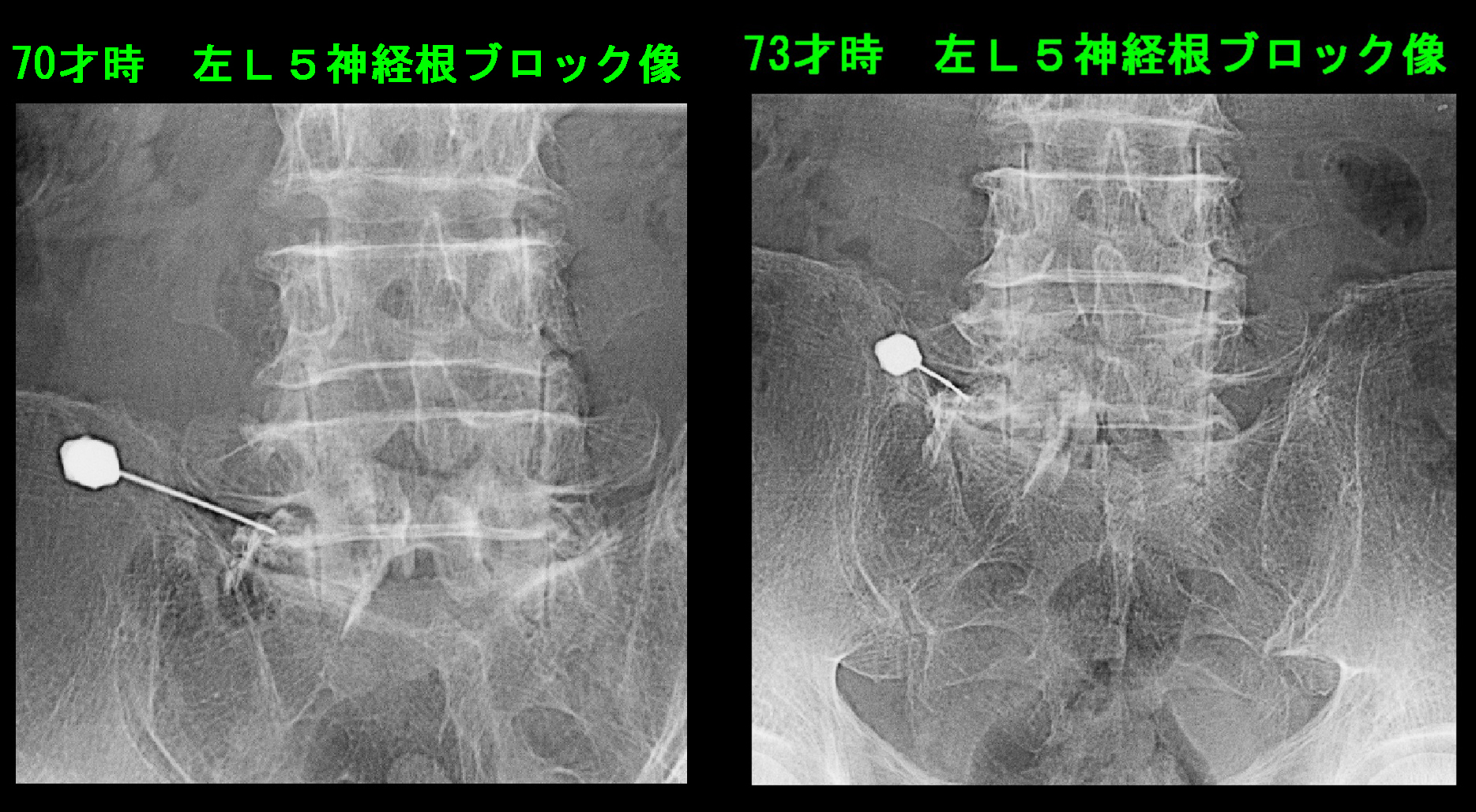 神経根ブロック像.jpg