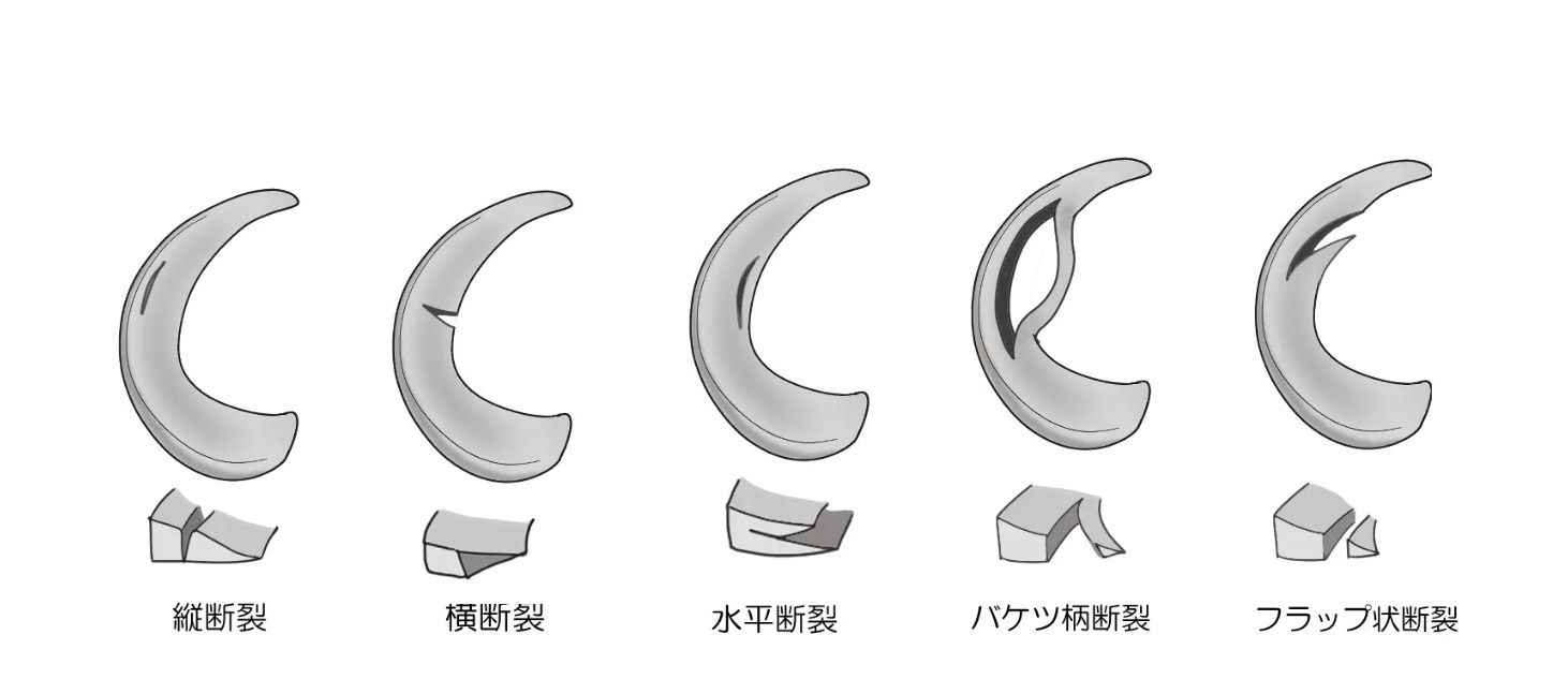 半月板損傷の形態.jpg