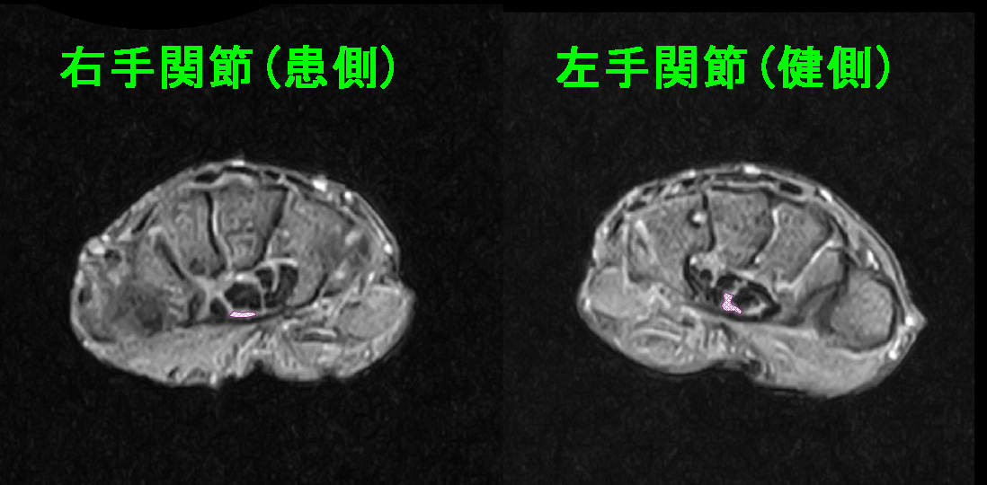 手根管MR１.jpg