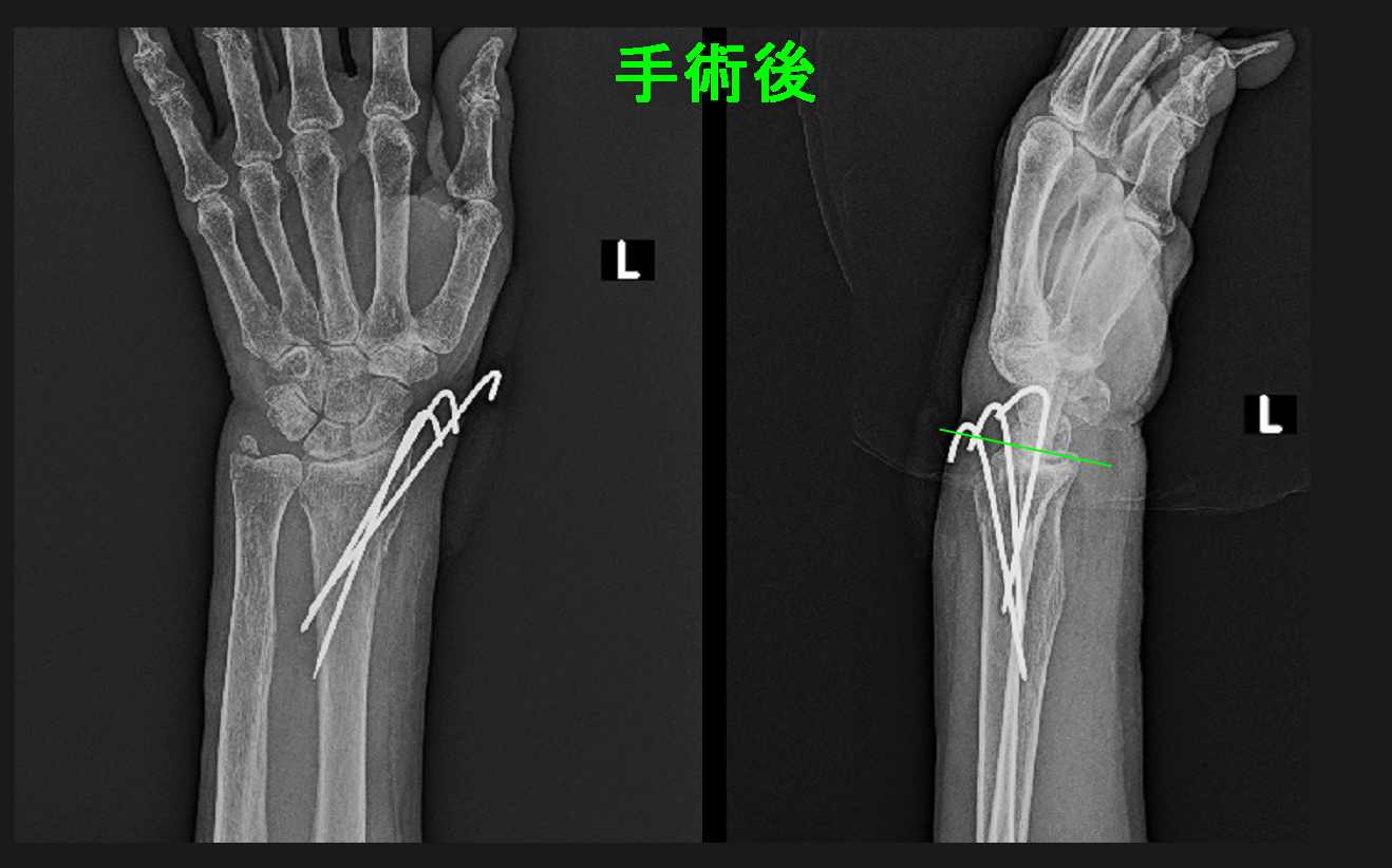 術後Xp.jpg