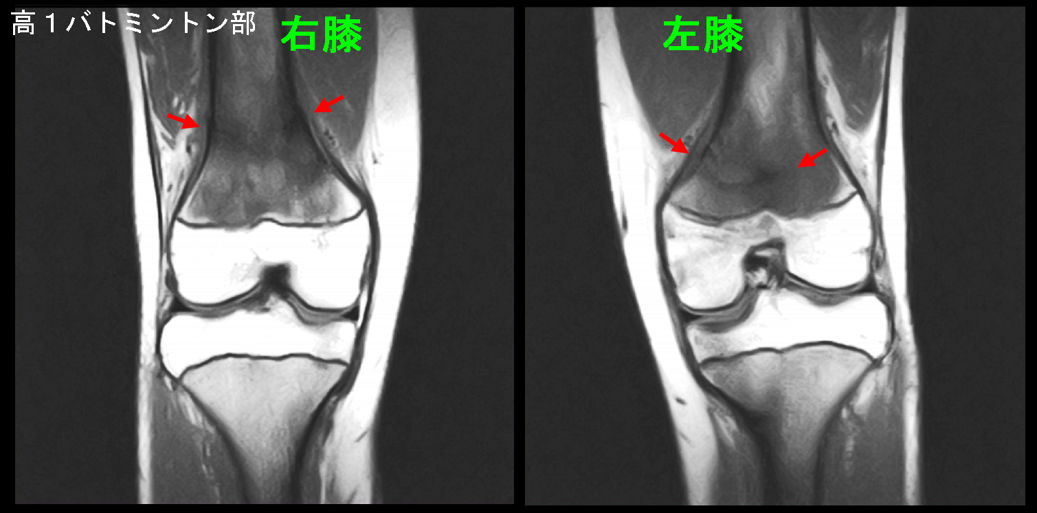 初診時MRI.jpg